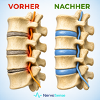 Beenden Sie Ihre Spinalkanalstenose & das Taubheitsgefühl in den Beinen ohne Operation, in nur 15 Minuten täglich